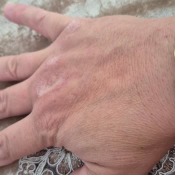 Fairy Markasının Yeni Mandalina Kokulu Sıvı El Sabunu Ciddi El Tahrişine Sebep Oldu