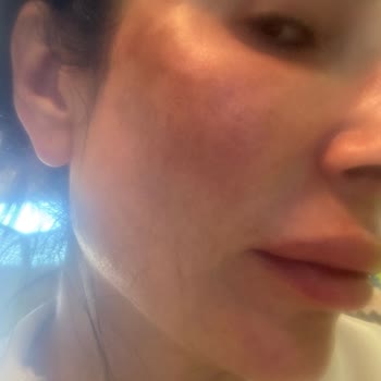 Krem Sonrası Yüzde Yanık Görüntüsü Ve Eczane İlgisizliği