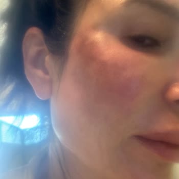 Krem Sonrası Yüzde Yanık Görüntüsü Ve Eczane İlgisizliği