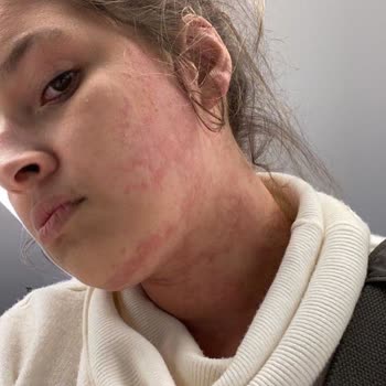 Temu'dan Alerjik Reaksiyon Yaratan Elbise İçin Koşulsuz İade Talebi