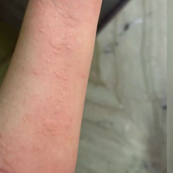 Temu'dan Alerjik Reaksiyon Yaratan Elbise İçin Koşulsuz İade Talebi