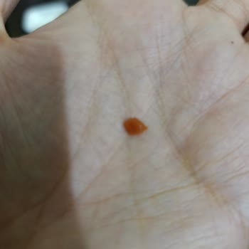 Sütaş Vişne Reçelinde Sert Parça Düşmesi Ve Diş Hasarı