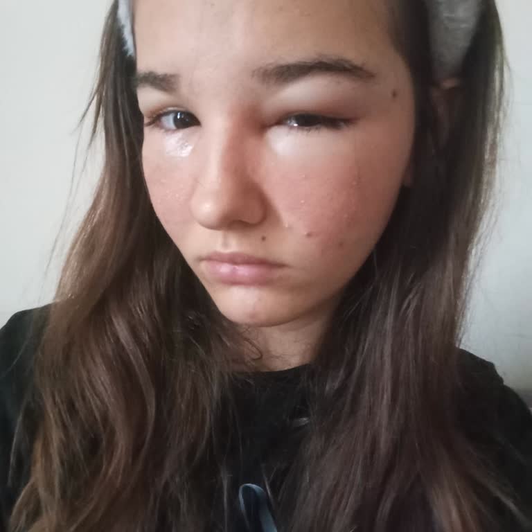 Bee Beauty Göz Maskesi Şiddetli Alerjik Reaksiyon Ve Sağlık Riski Oluşturdu