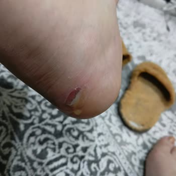 Vans Ayakkabısında Oluşan Derin Topuk Yarası Ve Değişim Talebi