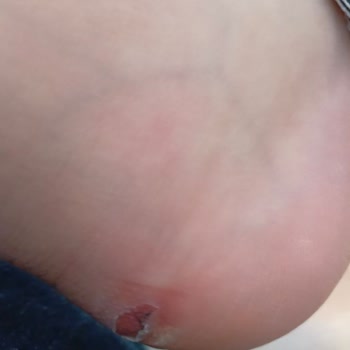 Vans Ayakkabısında Oluşan Derin Topuk Yarası Ve Değişim Talebi