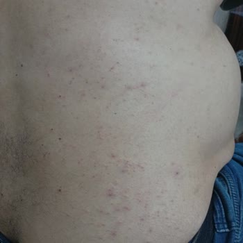 Watsons Kiraz Çiçeği Duş Jelinde Alerjik Reaksiyon Ve Sağlık Masrafları İçin İade Talebi