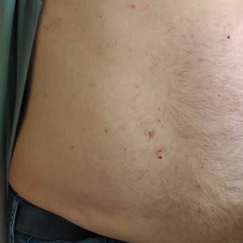 Watsons Kiraz Çiçeği Duş Jelinde Alerjik Reaksiyon Ve Sağlık Masrafları İçin İade Talebi