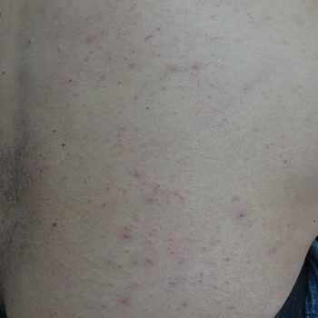 Watsons Kiraz Çiçeği Duş Jelinde Alerjik Reaksiyon Ve Sağlık Masrafları İçin İade Talebi