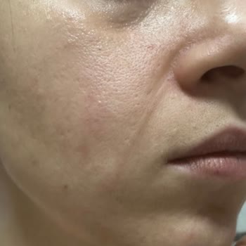 Benri Disk Pamuk Ürününün Ciltte Yırtılmaya Neden Olması