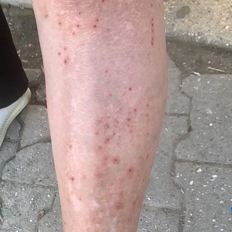 Sakarya Eğitim Araştırma Hastanesinde Cildiye Doktorunun Yüzeysel Muayenesi Ve Yetersiz Tedavisi