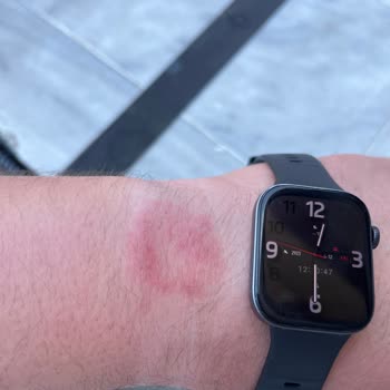Huawei Fit 3 Rötung und Krustenbildung am Handgelenk