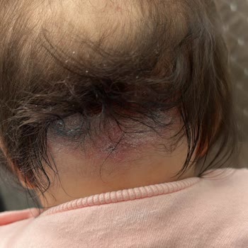 Mustela Stelatopia+ Kremi Bebek Cildinde Kızarıklık Ve Kuruluğu Şiddetle Artırdı
