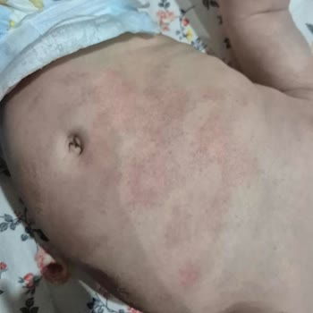 Mustela Stelatopia+ Kremi Bebek Cildinde Kızarıklık Ve Kuruluğu Şiddetle Artırdı