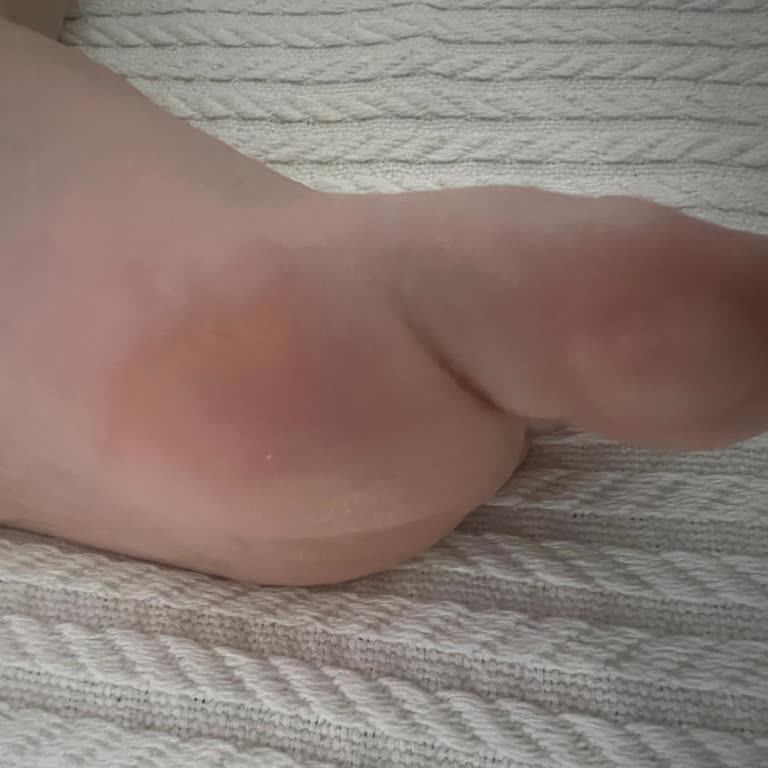 Ayak Ağrısına Ve Su Toplanmasına Neden Olan Asics Ayakkabının İadesi