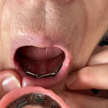 Beyaz İnci Diş Hastanesi'nde Yanıltıcı Implant Bilgilendirmesi Ve 98.200 TL İade Talebi