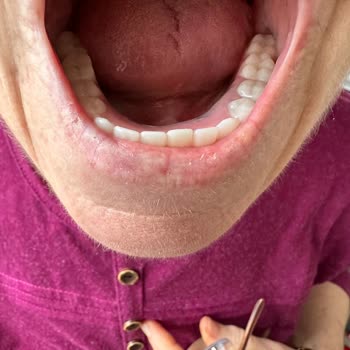 Beyaz İnci Diş Hastanesi'nde Yanıltıcı Implant Bilgilendirmesi Ve 98.200 TL İade Talebi