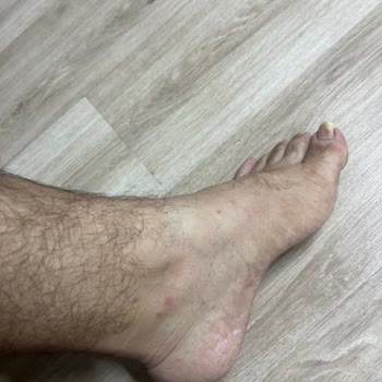 Tatilox Otelinde Hamile Eşin Sivrisinek Isırıkları Ve Ücret İadesi Talebi