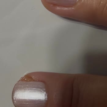 Gratis Beauty Bakırköy’de Dikkatsiz Manikür Sonrası Şiddetli Acı Ve Enfeksiyon
