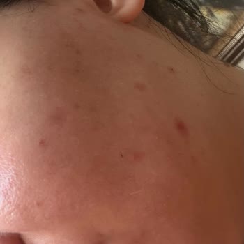 Nivea %5 Serum Makyaj Temizleme Suyunda Çıkan Sivilce Ve Kızarıklık Şikayeti