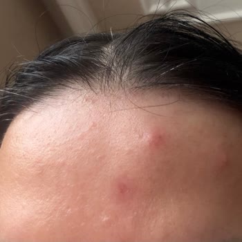 Nivea %5 Serum Makyaj Temizleme Suyunda Çıkan Sivilce Ve Kızarıklık Şikayeti