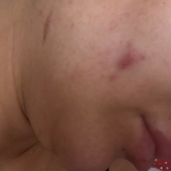 Nivea %5 Serum Makyaj Temizleme Suyunda Çıkan Sivilce Ve Kızarıklık Şikayeti