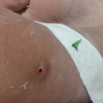 Acil Serviste Cam Parçası Tespit Edilememesi Ve Uzun Süreli Ağrı Şikayeti