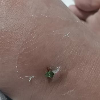 Acil Serviste Cam Parçası Tespit Edilememesi Ve Uzun Süreli Ağrı Şikayeti