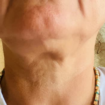 Gıdı Liposuction İşleminde Söz Verilen Gençleşme Gerçekleşmedi, Aksine Sarkma Ve Çöküntü Oluştu