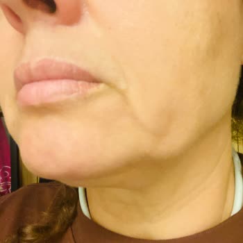 Gıdı Liposuction İşleminde Söz Verilen Gençleşme Gerçekleşmedi, Aksine Sarkma Ve Çöküntü Oluştu
