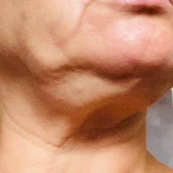 Gıdı Liposuction İşleminde Söz Verilen Gençleşme Gerçekleşmedi, Aksine Sarkma Ve Çöküntü Oluştu