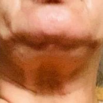 Gıdı Liposuction İşleminde Söz Verilen Gençleşme Gerçekleşmedi, Aksine Sarkma Ve Çöküntü Oluştu