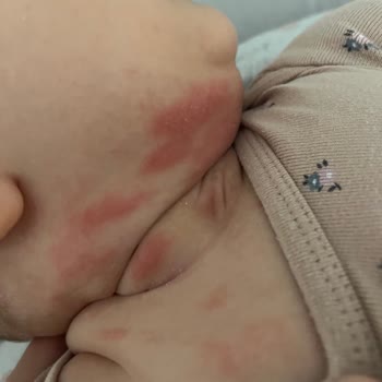 Mustela Stelatopia Kreminin Bebeğimde Oluşturduğu Şiddetli Tahriş Ve Döküntü
