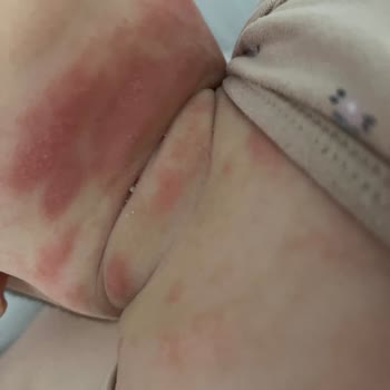 Mustela Stelatopia Kreminin Bebeğimde Oluşturduğu Şiddetli Tahriş Ve Döküntü