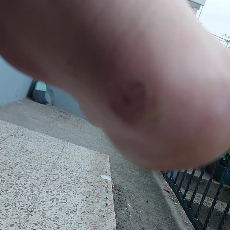 Oxide Ayakkabısının Ayağımı Vurması Ve İade Talebinin Reddedilmesi