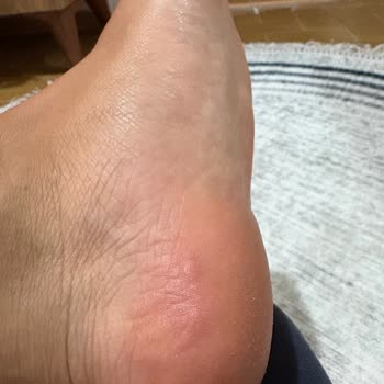 Reebok Ayakkabısının Yanma Ve Su Toplaması Nedeniyle Sağlık Sorunu Ve İade Talebi