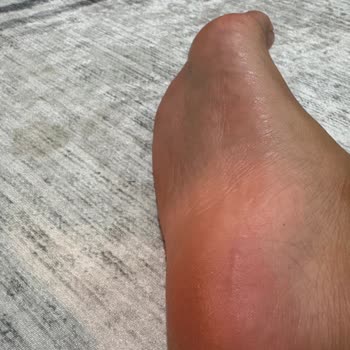 Reebok Ayakkabısının Yanma Ve Su Toplaması Nedeniyle Sağlık Sorunu Ve İade Talebi