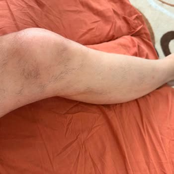 Enza Aesthetic Beauty'de Zorunlu Ek Ücret ve Tamamlanmamış Lazer Epilasyon Garantisi