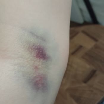 Stajyerin Yetersiz Kan Alma İşlemi Sonrası Ağrılı Ve Morluklu Kol Şikayeti
