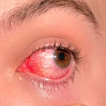 Mounjaro Enjektör Arızası Ve Göz Yaralanması Sonrası Şirketin İade Ve Değişim Reddi