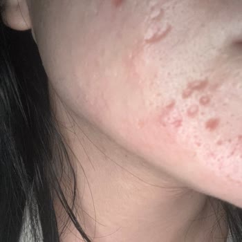 Hatalı Lazer Tedavisi, Kalıcı Skarlar Ve KVKK İhlali