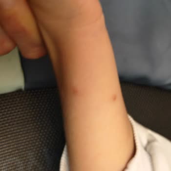 Ozmo Çikolatalı Ürünün Çocukta Alerjik Reaksiyonuna Dair Acil İnceleme Talebi
