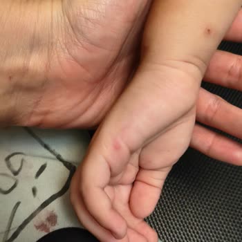 Ozmo Çikolatalı Ürünün Çocukta Alerjik Reaksiyonuna Dair Acil İnceleme Talebi