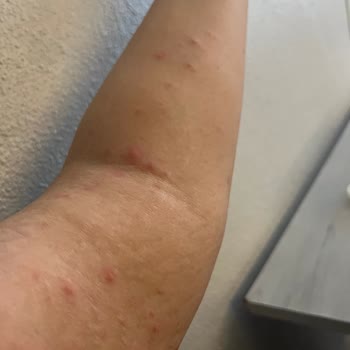 A101 Şubesinde Palmolive Duş Jelinden Şiddetli Alerjik Reaksiyon
