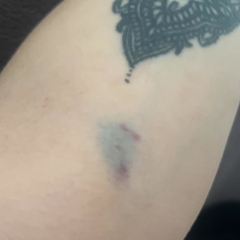 Acil Serviste Serum Uygulaması Sonrası Damar Morluğu Ve Personel İlgisizliği