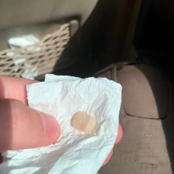 Diş Kaplaması Kısa Sürede Düşerek Ağrıya Neden Oldu, Hızlı Çözüm Talebi