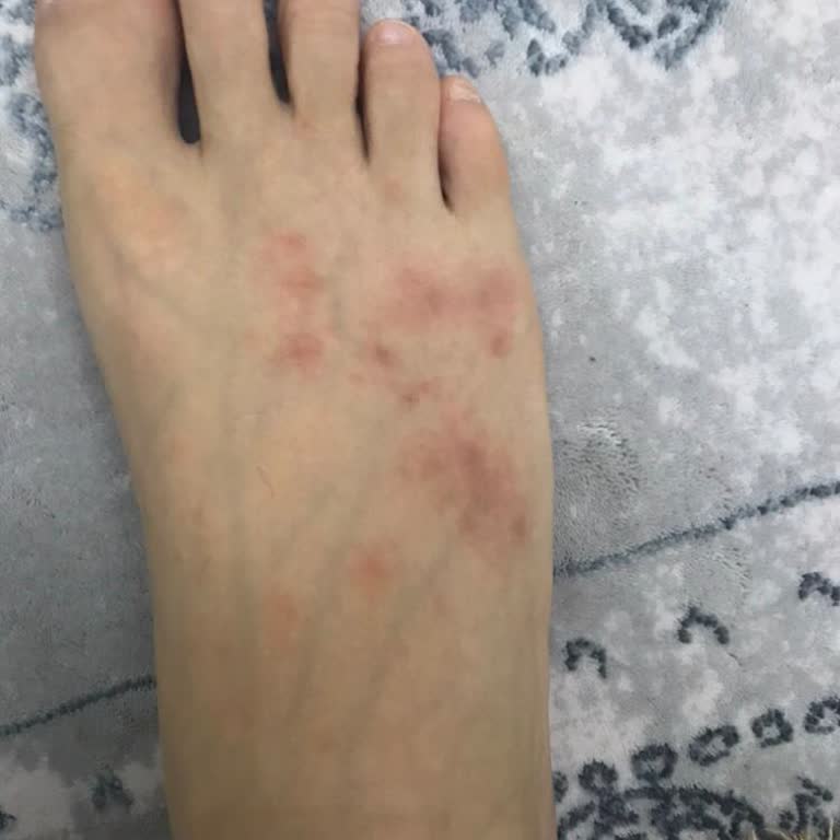 Lescon Safari 3 Ayakkabısının Alerjik Dermatit Oluşturması Ve İade Reddi