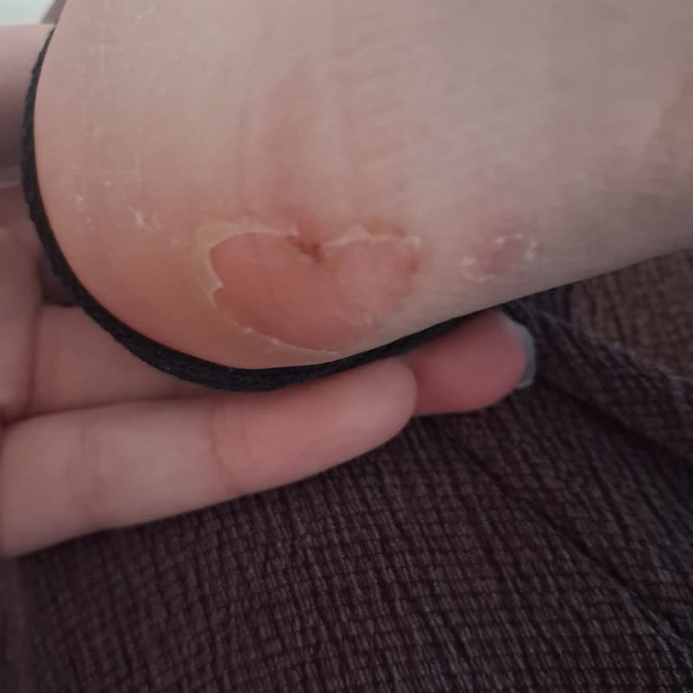 Torex Ayakkabısında Deri Soyulması Ve Değişim Talebi Reddedildi