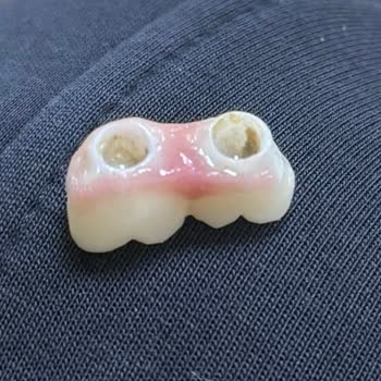 Denta Center İmplant Ve Porselen Dişin Tekrar Düşmesi Ve Kalıcı Çözüm Talebi