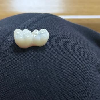 Denta Center İmplant Ve Porselen Dişin Tekrar Düşmesi Ve Kalıcı Çözüm Talebi