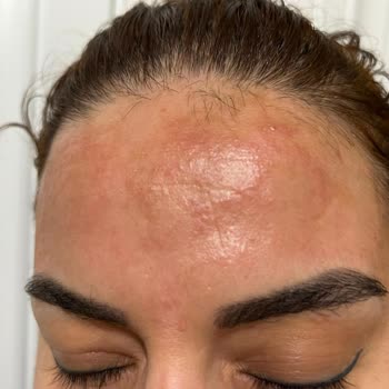 Batman Burak Gross Market’ten Satın Alınan Son Kullanma Tarihi Geçmiş Pantene Şampuan Seti Nedeniyle Saç Dökülmesi Ve Kimyasal Yanık